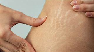 You are currently viewing Stretch Mark Removal Treatment in India – Professional Care for Noticeable Skin Improvement & Smoother Skin | Essence Skin Care