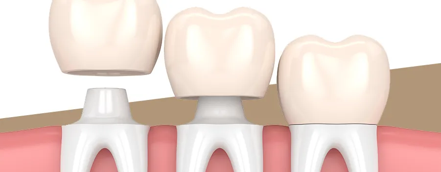 Read more about the article Dental Restoration Treatments That Protect Teeth Long Term