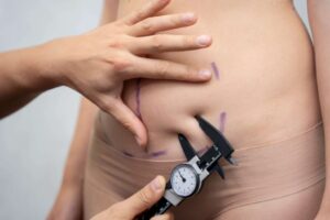 Read more about the article Who Is an Ideal Candidate for Liposuction?
