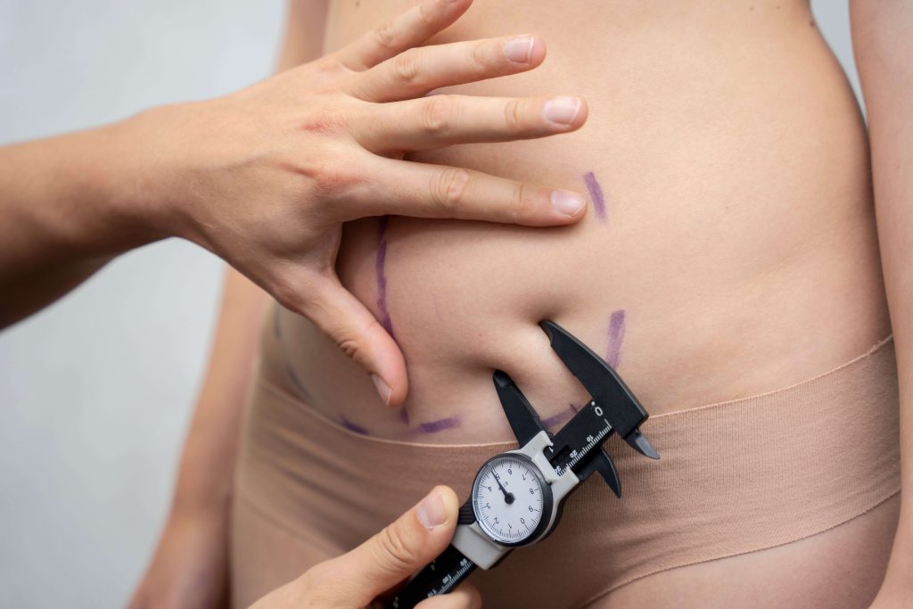 You are currently viewing Who Is an Ideal Candidate for Liposuction?