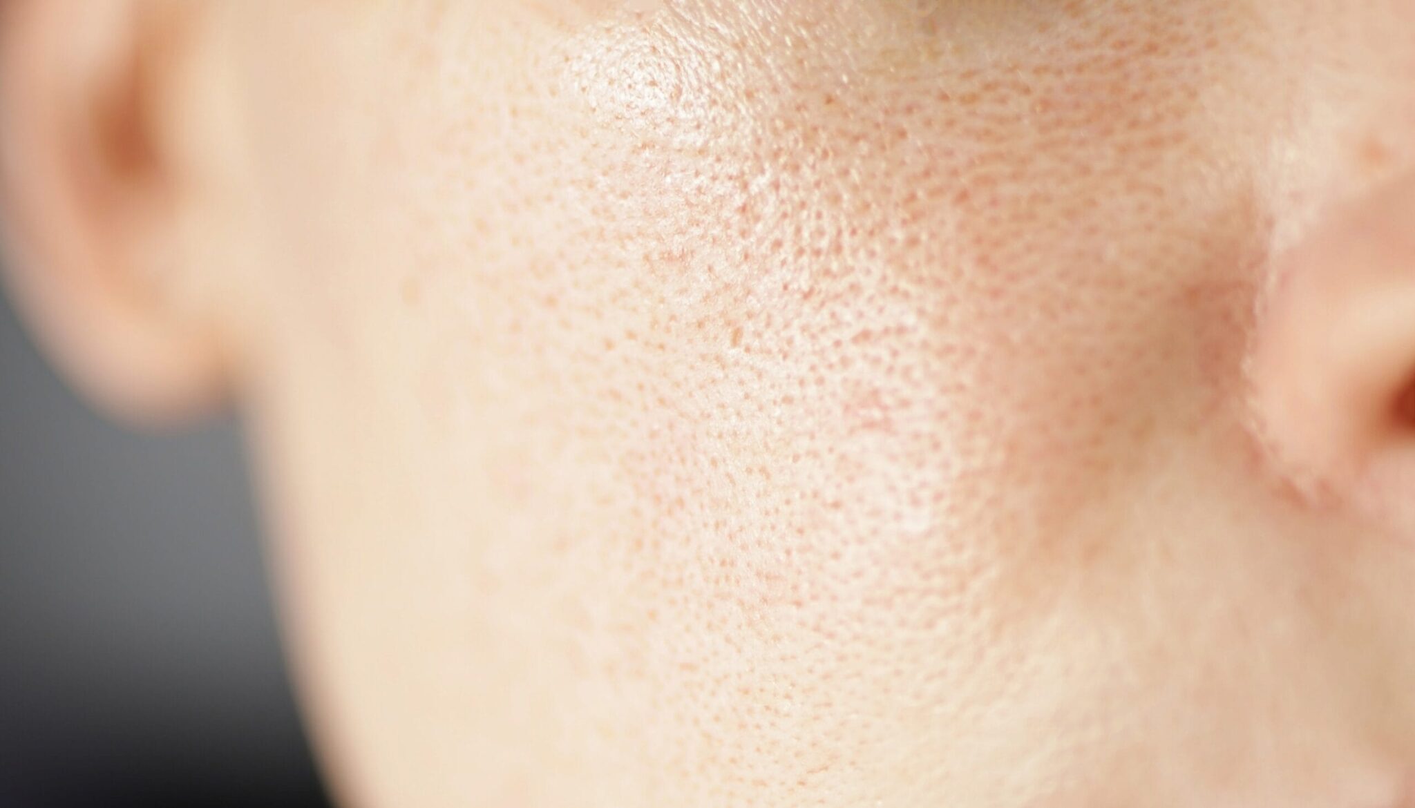 You are currently viewing Achieve Flawless Skin with Large Skin Pores Treatment in Dubai