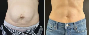 Read more about the article Beyond the Operating Room: Why a Plastic Surgery Recovery Nurse is Essential for Your Healing Journey