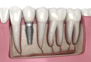 Read more about the article Your Trusted Hertfordshire Dentist for Dental Implants & Invisalign