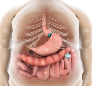 Read more about the article Is Gastric Band Ligation Right for You? A Complete Guide